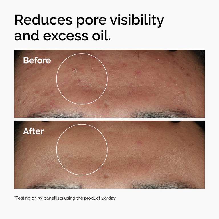 The Ordinary Niacinamide 10% + Zinc 1% Serum, 30ml, for Blemish-Prone Skin photo 2