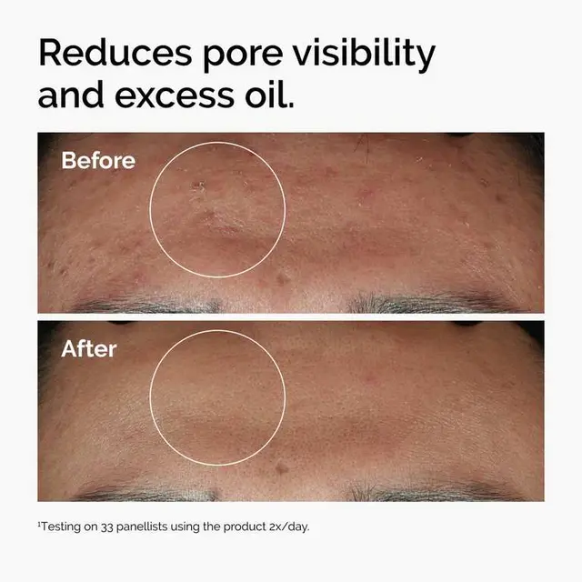The Ordinary Niacinamide 10% + Zinc 1% Serum, 30ml, for Blemish-Prone Skin photo 2